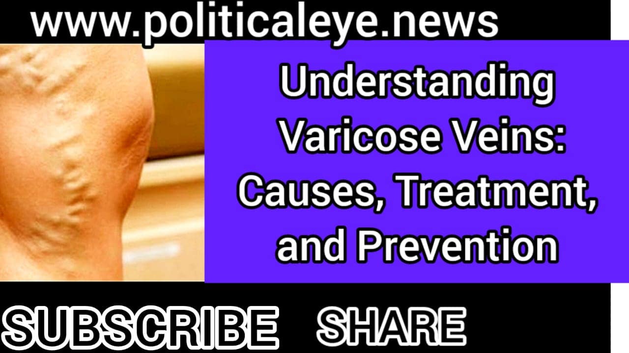Understanding Varicose Veins Causes Treatment and Prevention